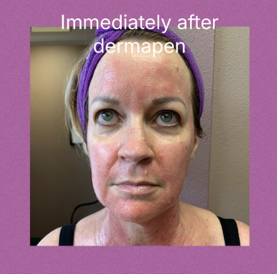 DermaPen microneedling with PRP